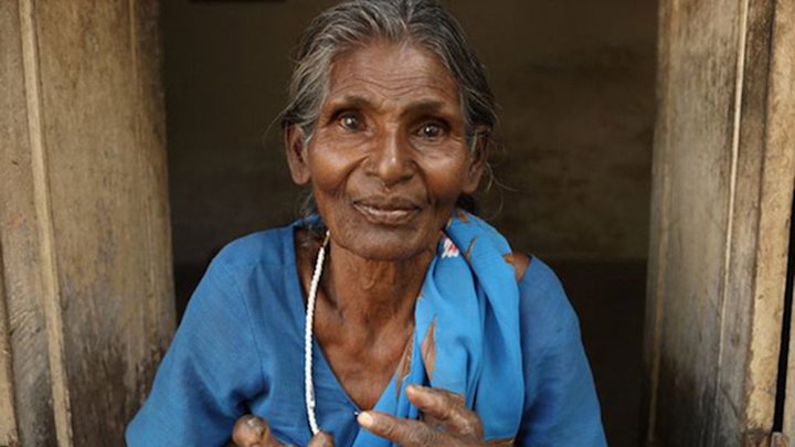Woman-with-leprosy