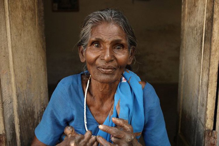 Woman-with-leprosy